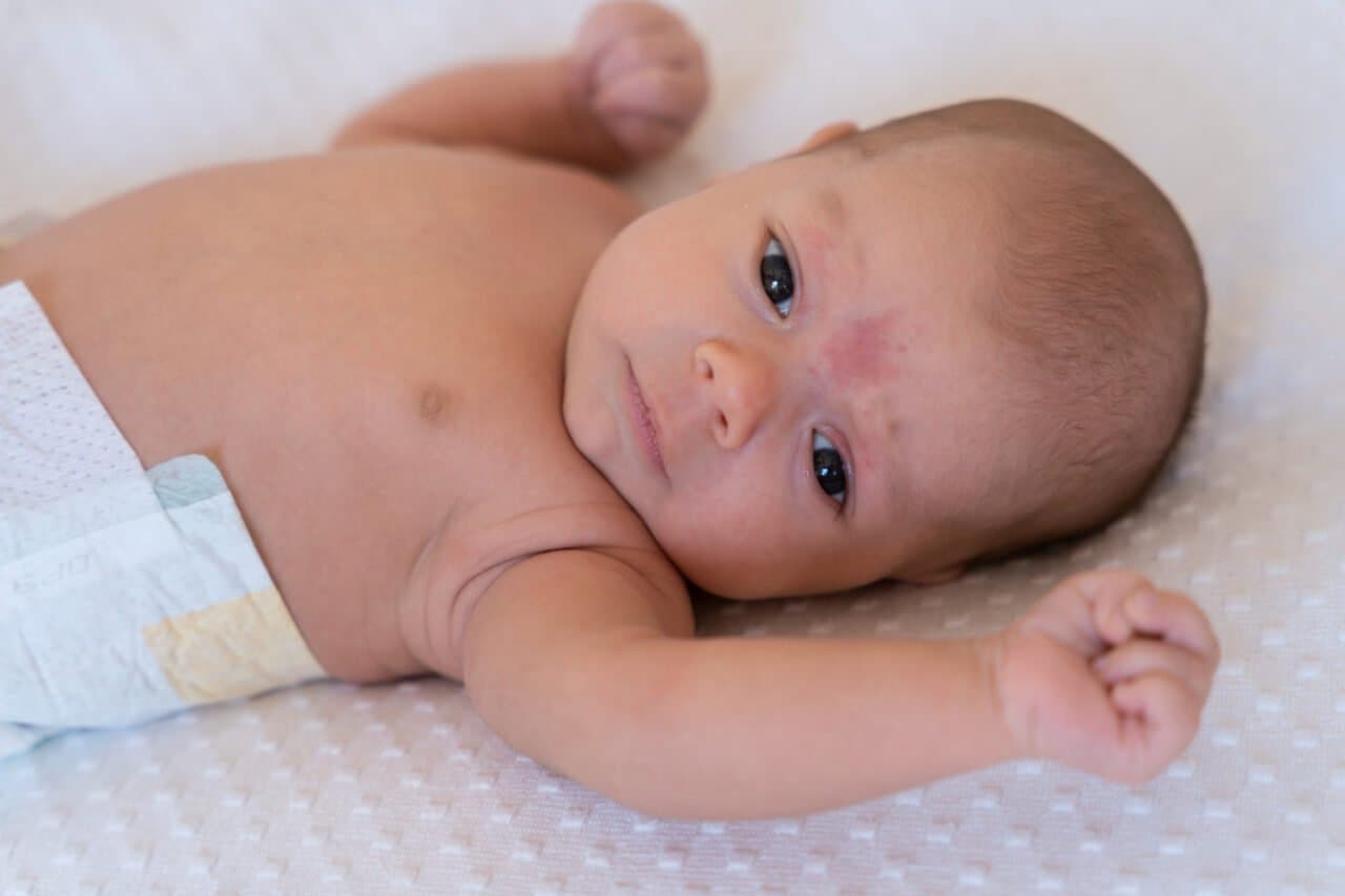 10 Masalah Kulit pada Bayi, Kenali Ciri dan Cara Mengatasinya
