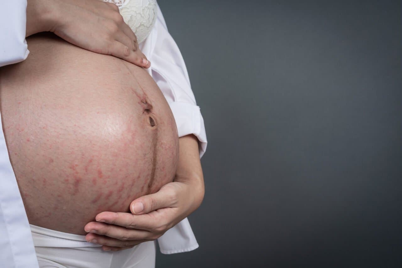 5 Gambaran Stretch Mark Saat Hamil & Cara Merawatnya